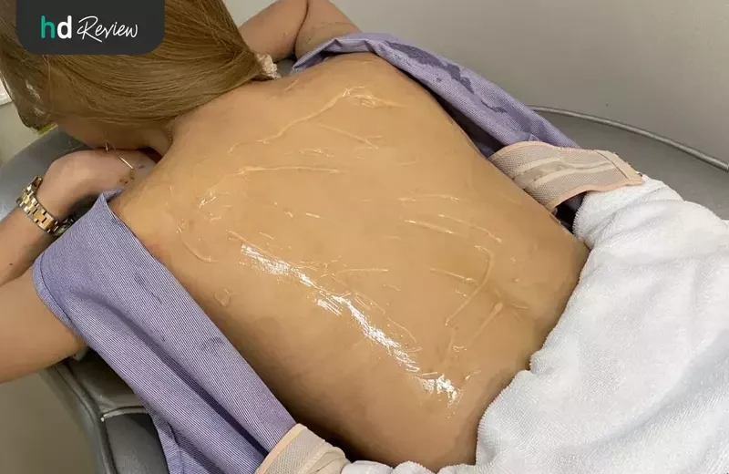 ขั้นตอนการรักษาสิวหลัง โปรแกรม Back Clear I ที่ Romrawin Clinic