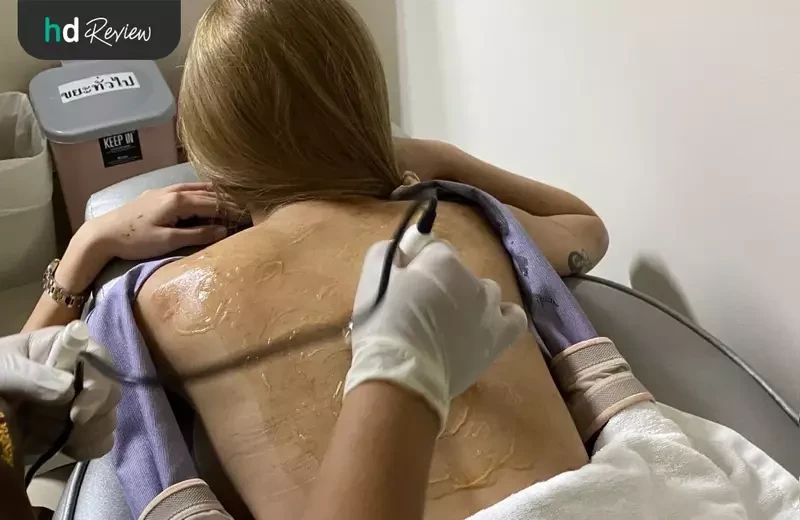ขั้นตอนการรักษาสิวหลัง โปรแกรม Back Clear I ที่ Romrawin Clinic