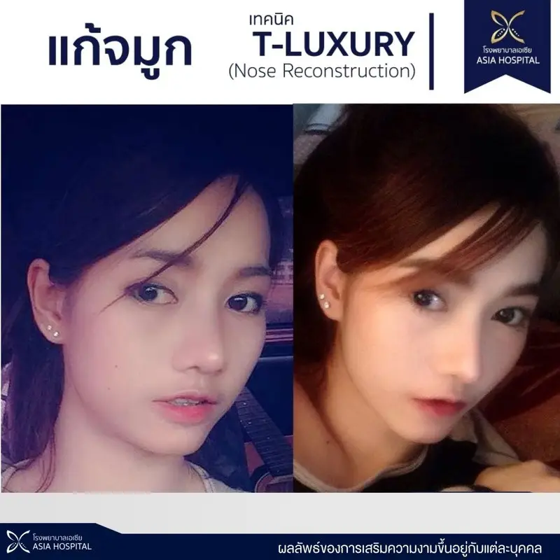 รีวิว แก้จมูก ด้วยเทคนิค T-luxury Nose ที่ โรงพยาบาลเอเซีย