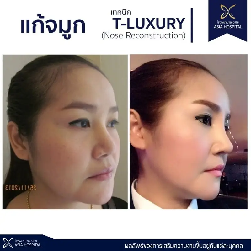 รีวิว แก้จมูก ด้วยเทคนิค T-luxury Nose ที่ โรงพยาบาลเอเซีย