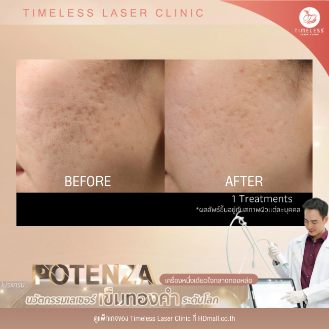 ผลลัพธ์หลังใช้บริการโปรแกรม Potenza ที่ Timeless Laser Clinic รูป 1