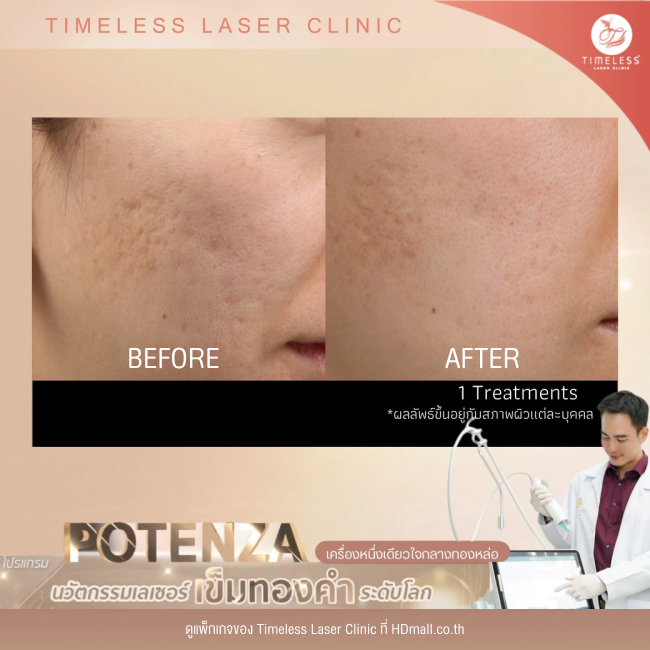 ผลลัพธ์หลังใช้บริการโปรแกรม Potenza ที่ Timeless Laser Clinic รูป 2