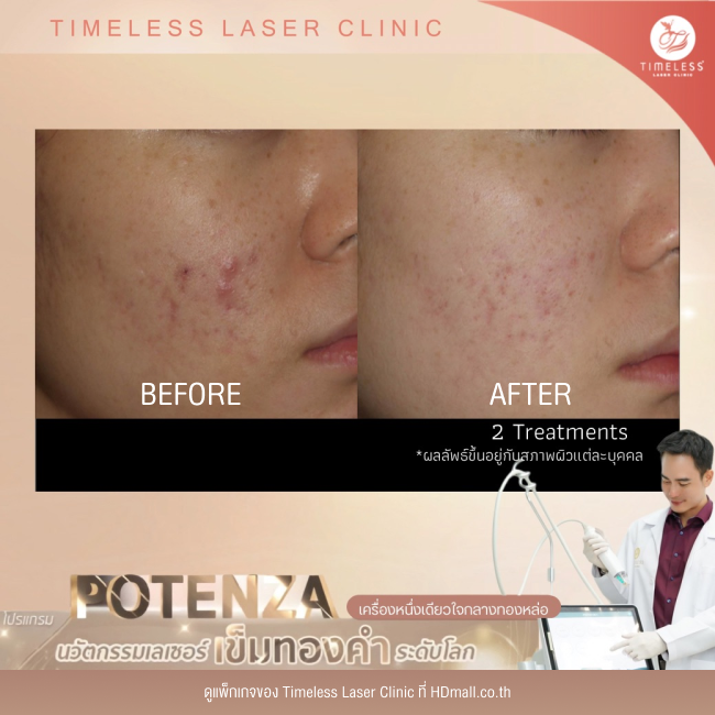 ผลลัพธ์หลังใช้บริการโปรแกรม Potenza ที่ Timeless Laser Clinic รูป 3