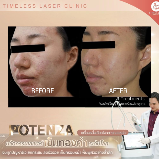 ผลลัพธ์หลังใช้บริการโปรแกรม Potenza ที่ Timeless Laser Clinic รูป 4
