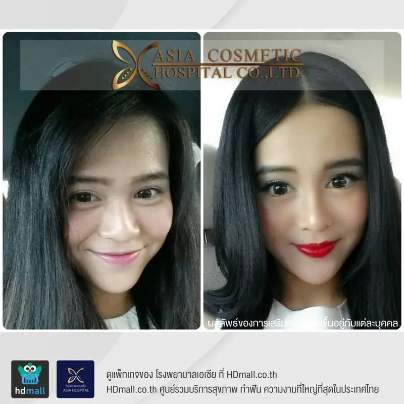 content review before after alar reduction surgery at asia hospital 2