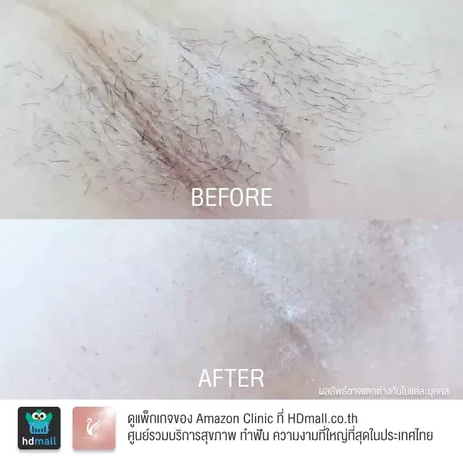 รีวิว เลเซอร์กำจัดขนรักแร้ ที่ Amazon Clinic