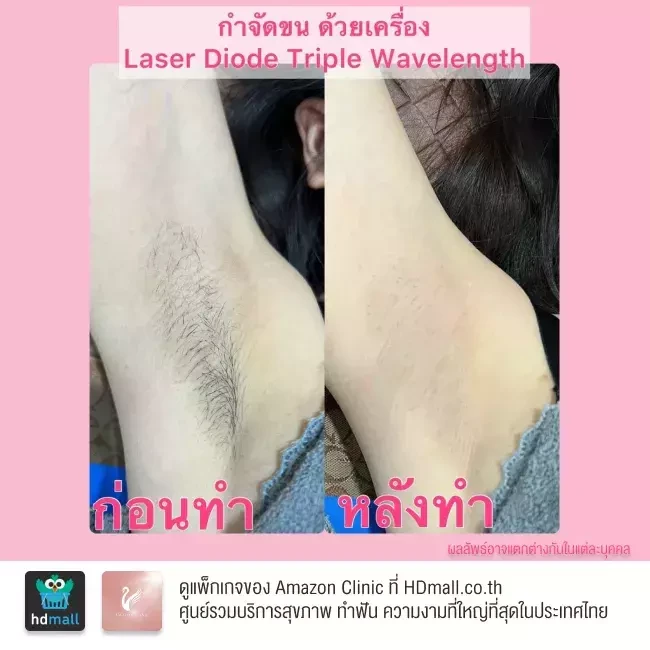 รีวิว เลเซอร์กำจัดขนรักแร้ ที่ Amazon Clinic
