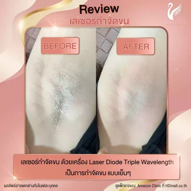 รีวิว เลเซอร์กำจัดขนรักแร้ ที่ Amazon Clinic