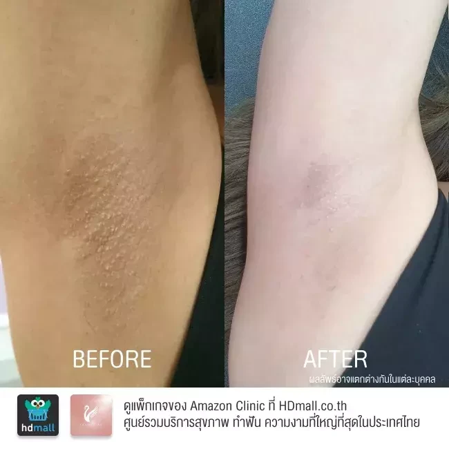 รีวิว เลเซอร์กำจัดขนรักแร้ ที่ Amazon Clinic