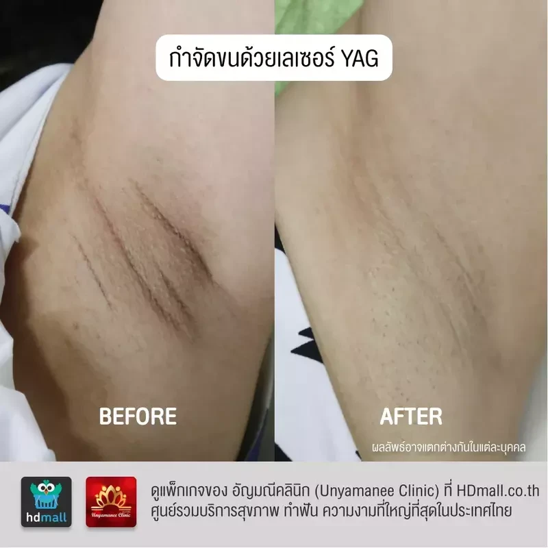 รีวิว กำจัดขนรักแร้ ที่ อัญมณีคลินิก Unyamanee clinic