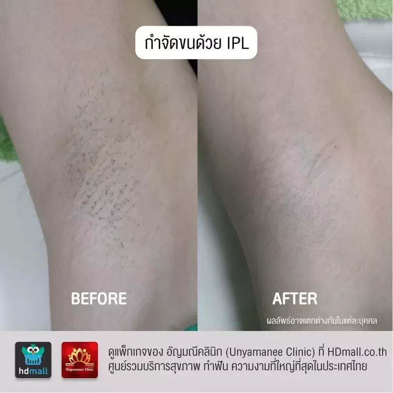 รีวิว กำจัดขนรักแร้ ที่ อัญมณีคลินิก Unyamanee clinic
