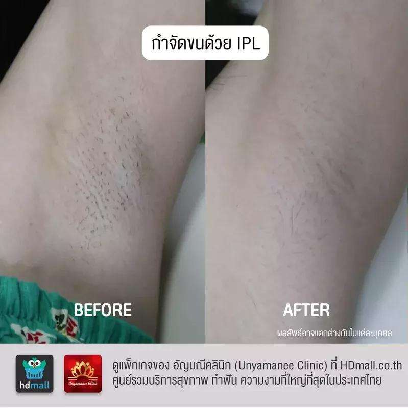 รีวิว กำจัดขนรักแร้ ที่ อัญมณีคลินิก Unyamanee clinic
