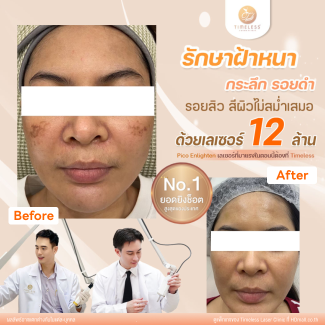 ผลลัพธ์หลังใช้บริการโปรแกรม Pico Enlighten ที่ Timeless Laser Clinic รูป 9