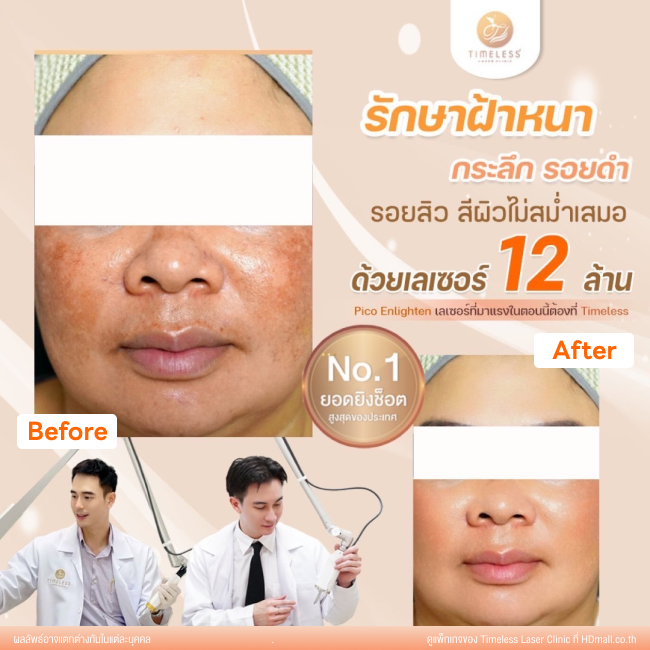 ผลลัพธ์หลังใช้บริการโปรแกรม Pico Enlighten ที่ Timeless Laser Clinic รูป 11