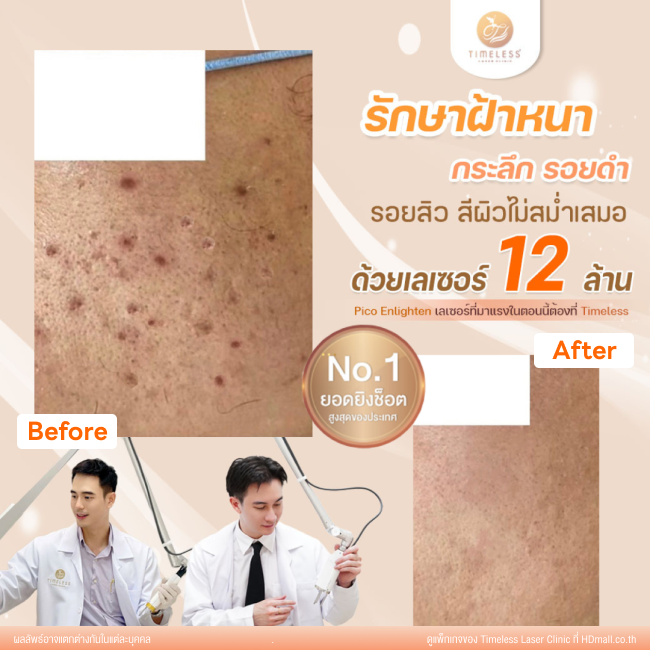 ผลลัพธ์หลังใช้บริการโปรแกรม Pico Enlighten ที่ Timeless Laser Clinic รูป 12