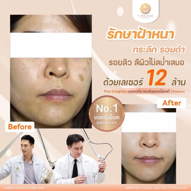 ผลลัพธ์หลังใช้บริการโปรแกรม Pico Enlighten ที่ Timeless Laser Clinic รูป 13