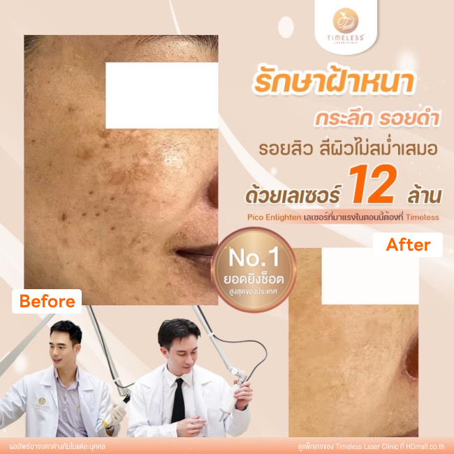 ผลลัพธ์หลังใช้บริการโปรแกรม Pico Enlighten ที่ Timeless Laser Clinic รูป 14