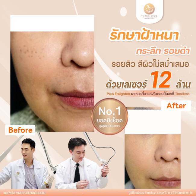ผลลัพธ์หลังใช้บริการโปรแกรม Pico Enlighten ที่ Timeless Laser Clinic รูป 15