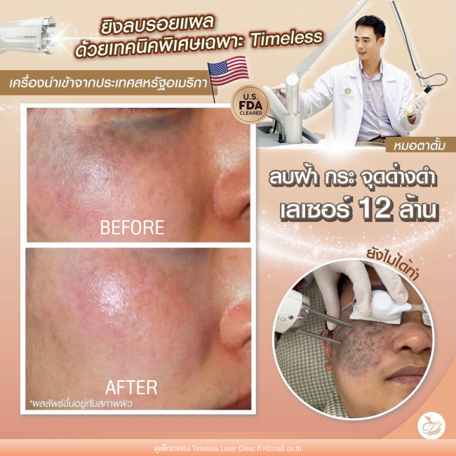 ผลลัพธ์หลังใช้บริการโปรแกรม Pico Enlighten ที่ Timeless Laser Clinic รูป 16