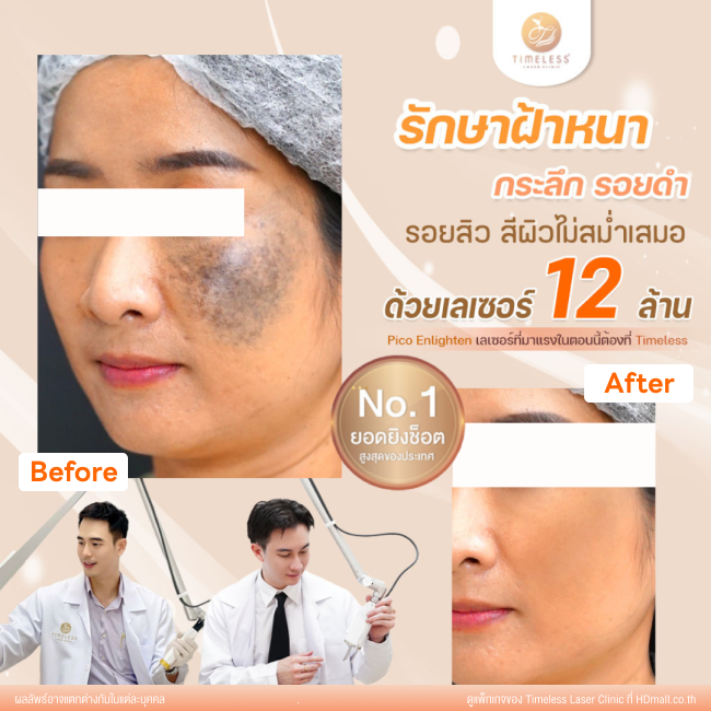 ผลลัพธ์หลังใช้บริการโปรแกรม Pico Enlighten ที่ Timeless Laser Clinic รูป 1
