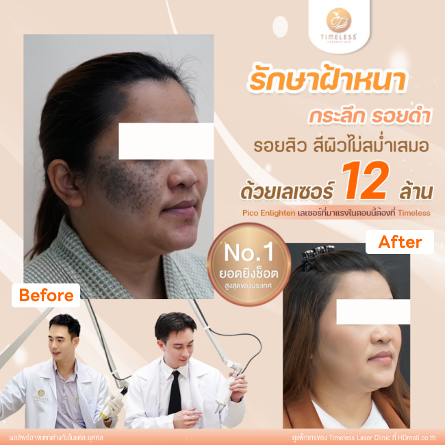 ผลลัพธ์หลังใช้บริการโปรแกรม Pico Enlighten ที่ Timeless Laser Clinic รูป 2