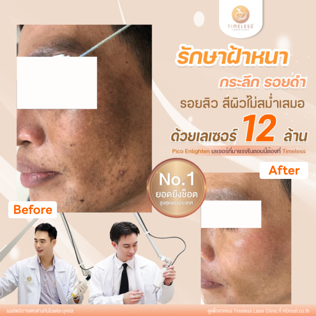 ผลลัพธ์หลังใช้บริการโปรแกรม Pico Enlighten ที่ Timeless Laser Clinic รูป 3