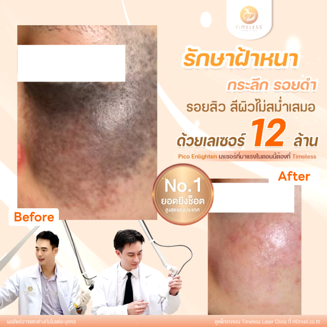 ผลลัพธ์หลังใช้บริการโปรแกรม Pico Enlighten ที่ Timeless Laser Clinic รูป