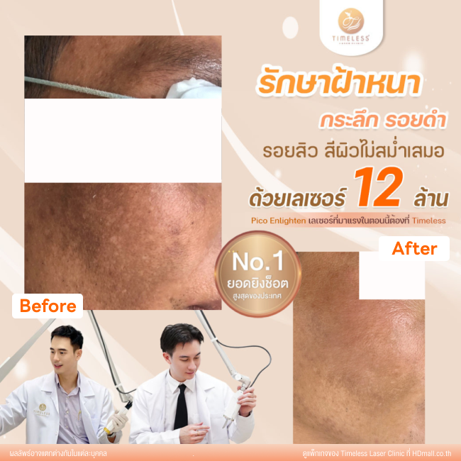 ผลลัพธ์หลังใช้บริการโปรแกรม Pico Enlighten ที่ Timeless Laser Clinic รูป 5