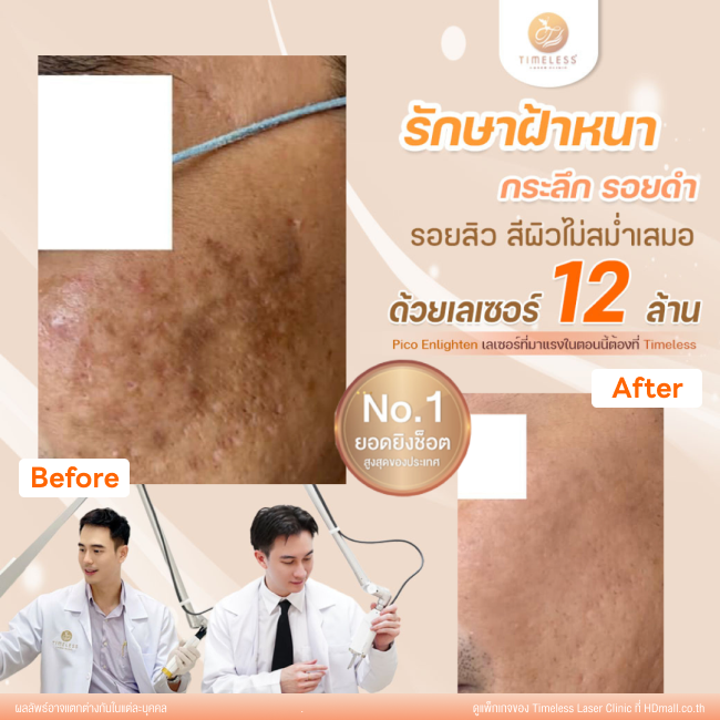 ผลลัพธ์หลังใช้บริการโปรแกรม Pico Enlighten ที่ Timeless Laser Clinic รูป 6
