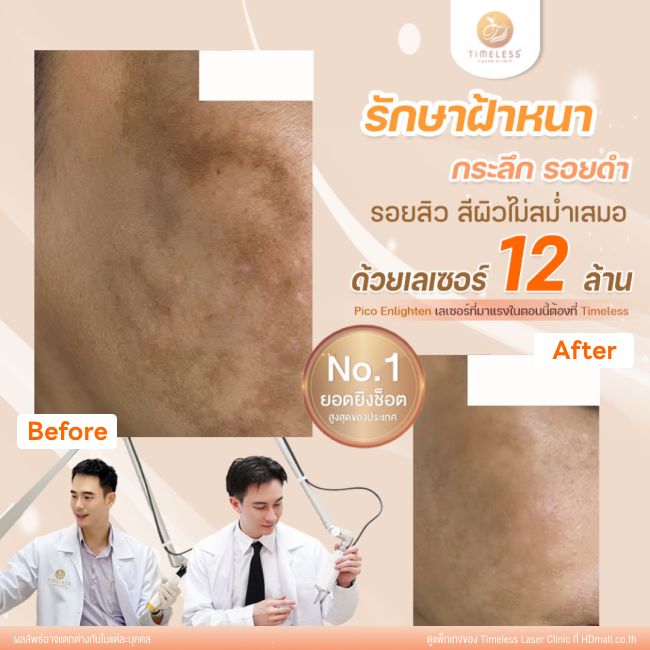 ผลลัพธ์หลังใช้บริการโปรแกรม Pico Enlighten ที่ Timeless Laser Clinic รูป 7