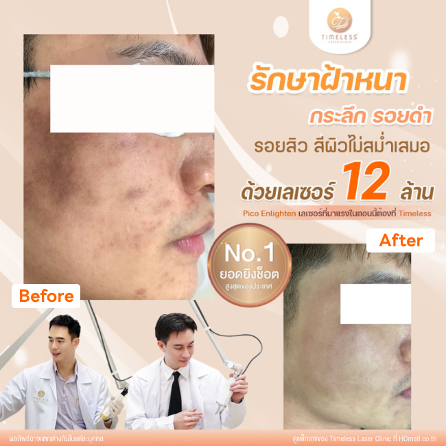 ผลลัพธ์หลังใช้บริการโปรแกรม Pico Enlighten ที่ Timeless Laser Clinic รูป 8
