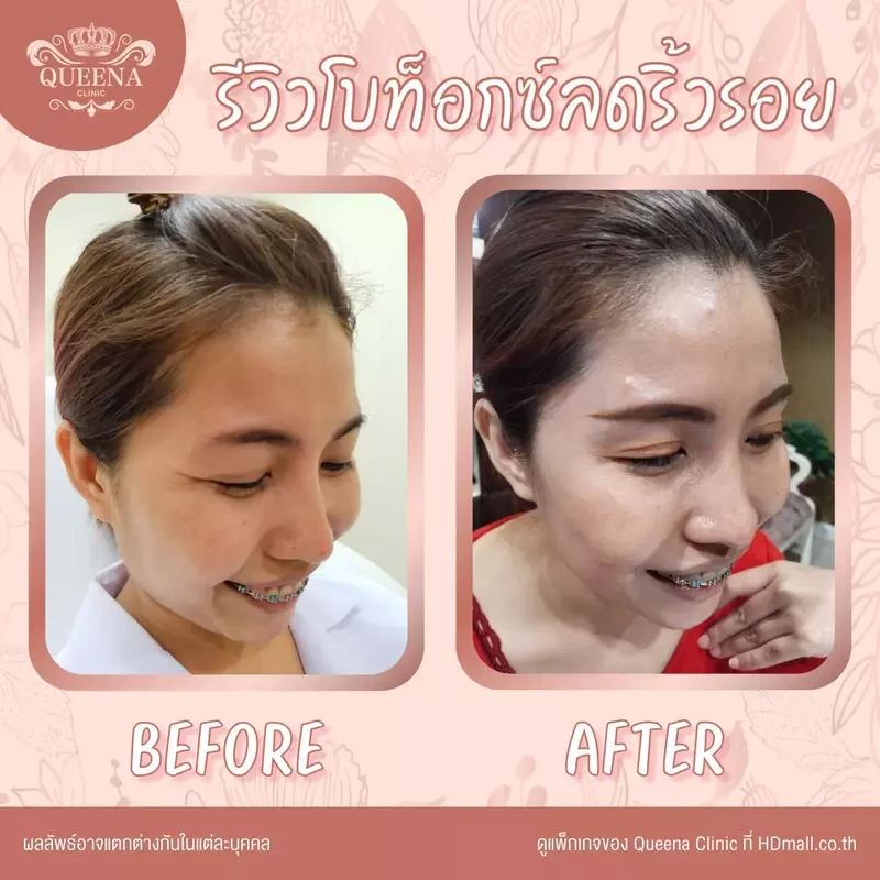 รีวิว ฉีดโบท็อกซ์ ที่ Queena Clinic