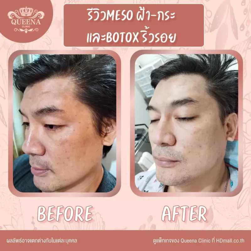 รีวิว ฉีดโบท็อกซ์ ที่ Queena Clinic