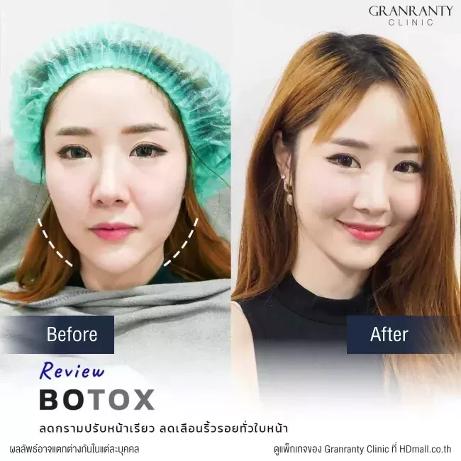 รีวิว ฉีดโบท็อกซ์ ลดกราม ปรับหน้าเรียว ที่ Granranty Clinic