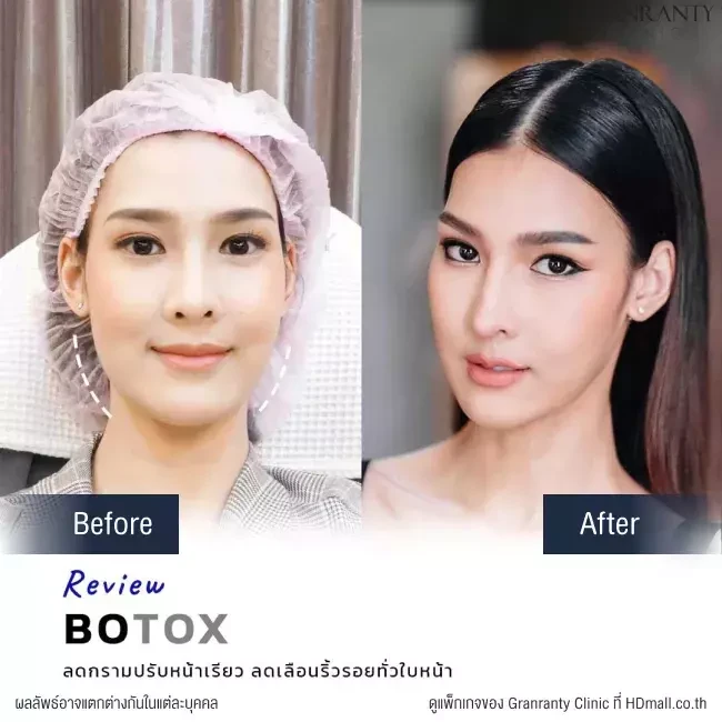 รีวิว ฉีดโบท็อกซ์ ลดกราม ปรับหน้าเรียว ที่ Granranty Clinic
