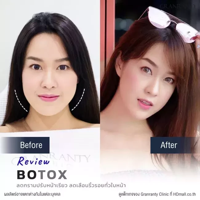 รีวิว ฉีดโบท็อกซ์ ลดกราม ปรับหน้าเรียว ที่ Granranty Clinic
