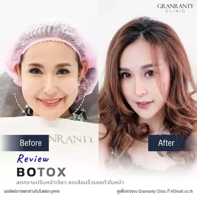 รีวิว ฉีดโบท็อกซ์ ลดกราม ปรับหน้าเรียว ที่ Granranty Clinic