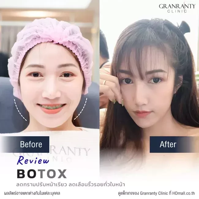รีวิว ฉีดโบท็อกซ์ ลดกราม ปรับหน้าเรียว ที่ Granranty Clinic