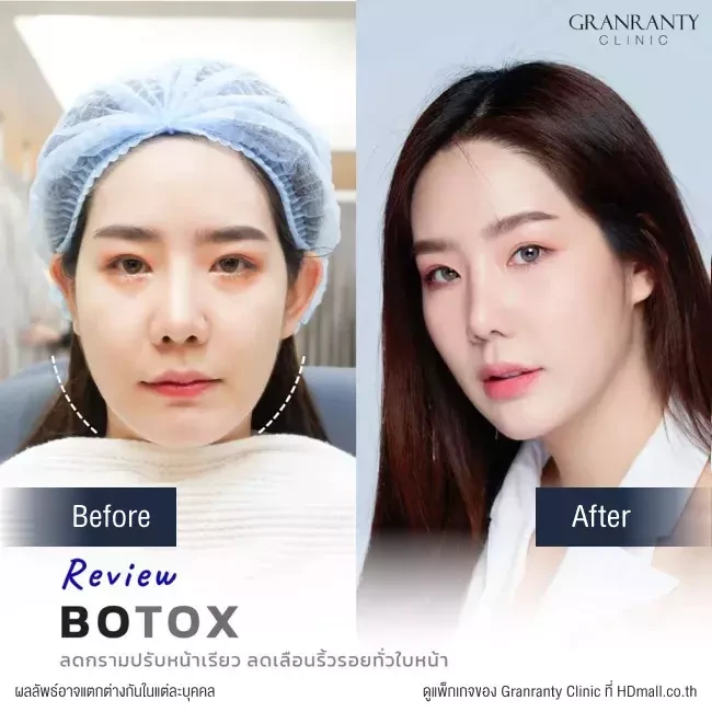 รีวิว ฉีดโบท็อกซ์ ลดกราม ปรับหน้าเรียว ที่ Granranty Clinic