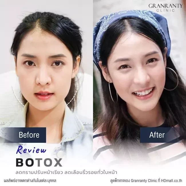 รีวิว ฉีดโบท็อกซ์ ลดกราม ปรับหน้าเรียว ที่ Granranty Clinic