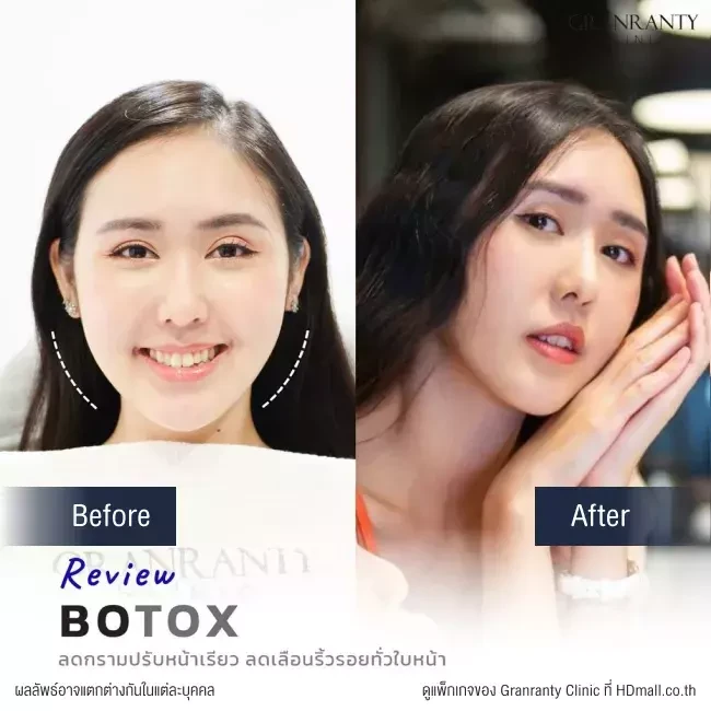 รีวิว ฉีดโบท็อกซ์ ลดกราม ปรับหน้าเรียว ที่ Granranty Clinic