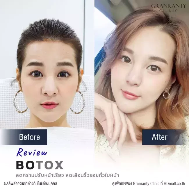 รีวิว ฉีดโบท็อกซ์ ลดกราม ปรับหน้าเรียว ที่ Granranty Clinic