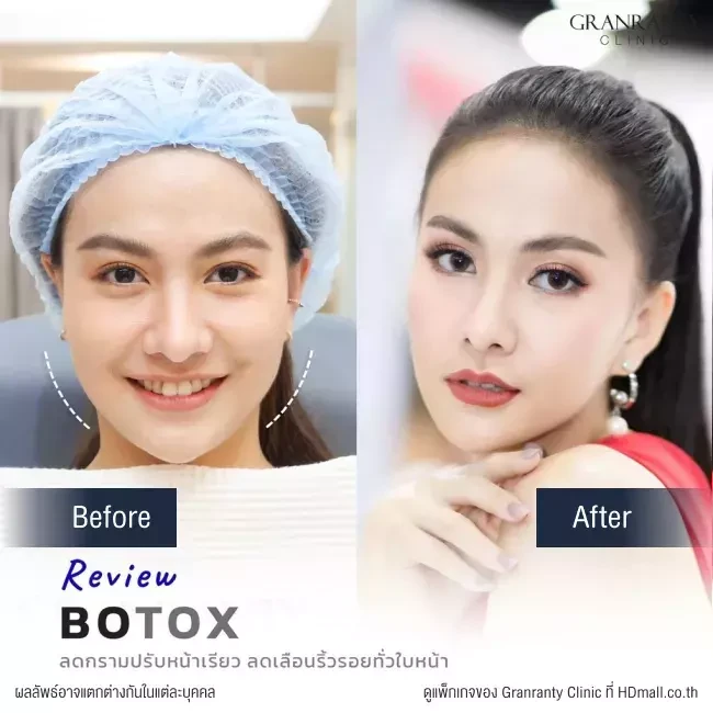 รีวิว ฉีดโบท็อกซ์ ลดกราม ปรับหน้าเรียว ที่ Granranty Clinic