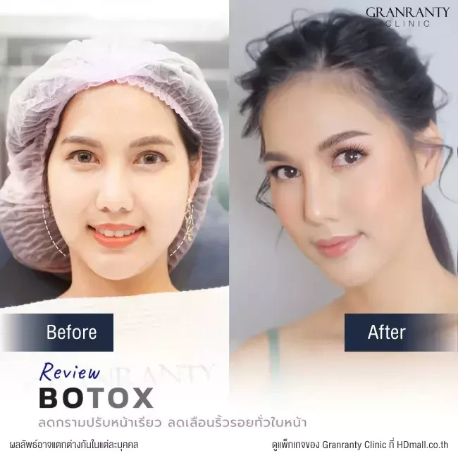 รีวิว ฉีดโบท็อกซ์ ลดกราม ปรับหน้าเรียว ที่ Granranty Clinic