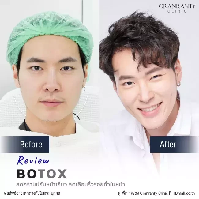 รีวิว ฉีดโบท็อกซ์ ลดกราม ปรับหน้าเรียว ที่ Granranty Clinic