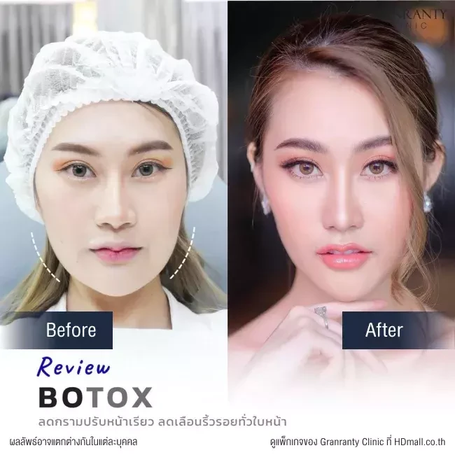 รีวิว ฉีดโบท็อกซ์ ลดกราม ปรับหน้าเรียว ที่ Granranty Clinic