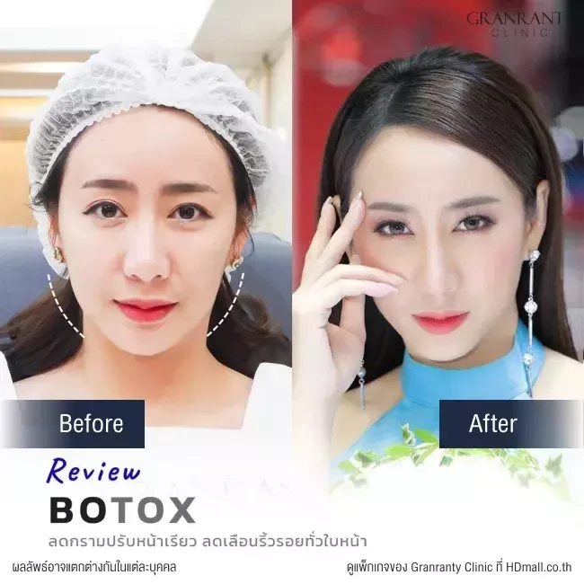 รีวิว ฉีดโบท็อกซ์ ลดกราม ปรับหน้าเรียว ที่ Granranty Clinic
