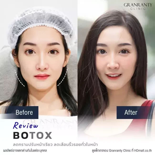 รีวิว ฉีดโบท็อกซ์ ลดกราม ปรับหน้าเรียว ที่ Granranty Clinic