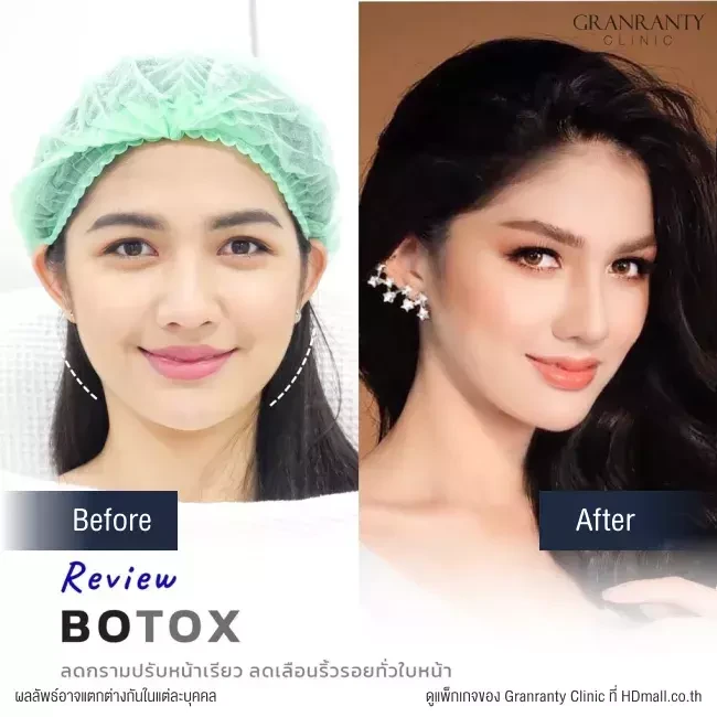 รีวิว ฉีดโบท็อกซ์ ลดกราม ปรับหน้าเรียว ที่ Granranty Clinic