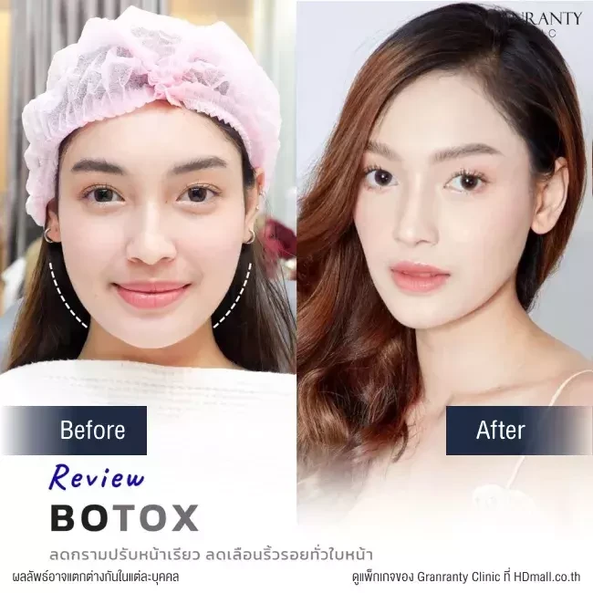 รีวิว ฉีดโบท็อกซ์ ลดกราม ปรับหน้าเรียว ที่ Granranty Clinic
